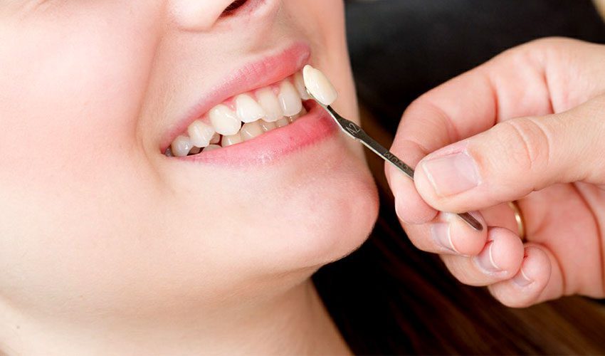 dental-veneers