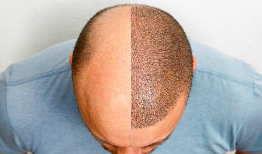 hair-transplant
